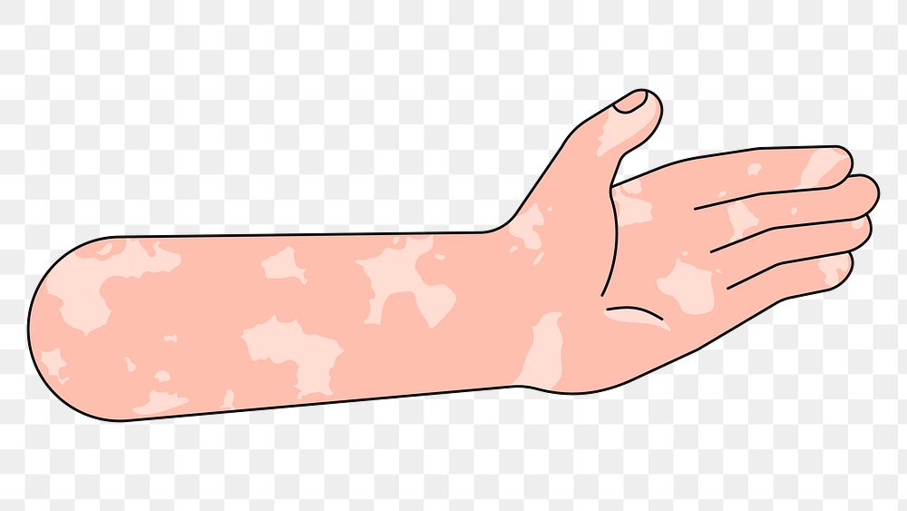 PNG Vitiligo palm hand, gesture flat illustration, transparent background