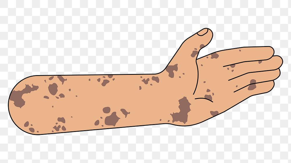 PNG Vitiligo palm hand, gesture flat illustration, transparent background