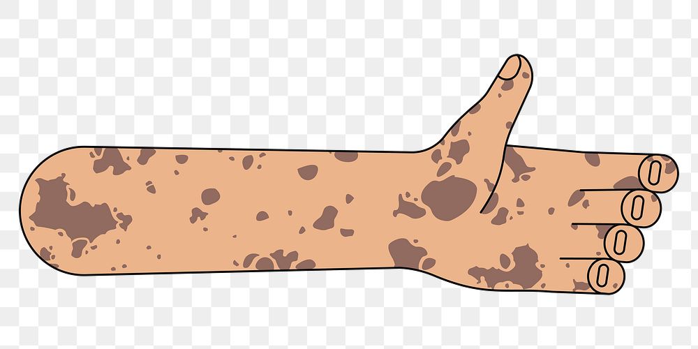 PNG Vitiligo palm hand, gesture flat illustration, transparent background