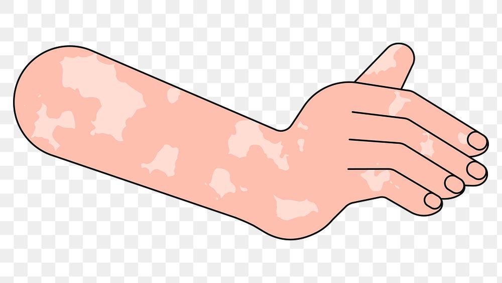 PNG White vitiligo hand gesture, flat illustration, transparent background