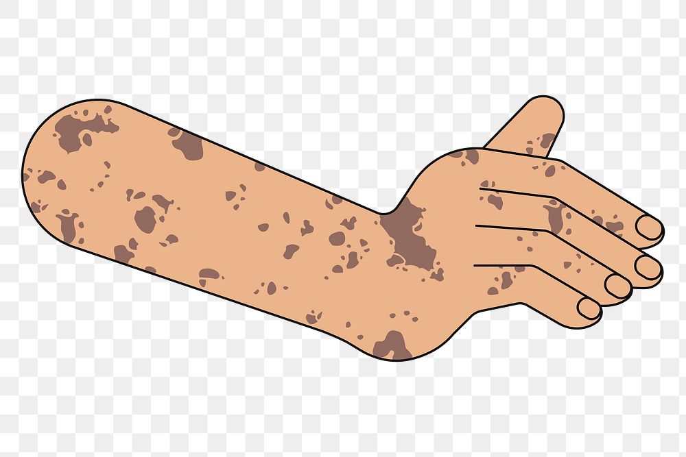 PNG Tanned vitiligo hand gesture, flat illustration, transparent background