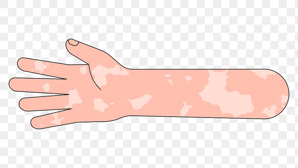 PNG White vitiligo hand arm, gesture illustration, transparent background