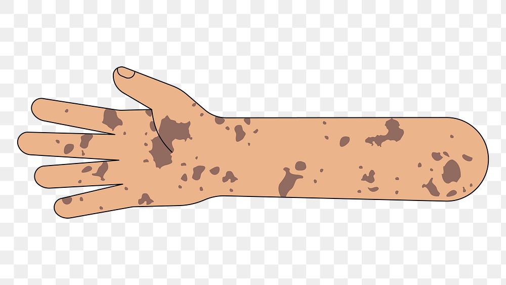 PNG Tanned vitiligo hand arm, gesture illustration, transparent background