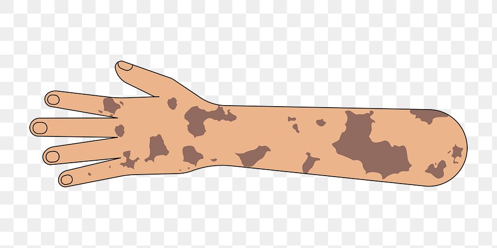 PNG Tanned vitiligo hand gesture, flat illustration, transparent background