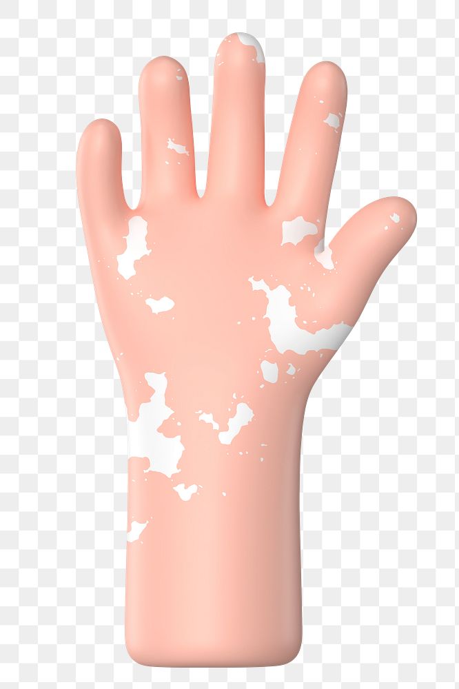 Raised vitiligo hand png gesture, 3D illustration, transparent background