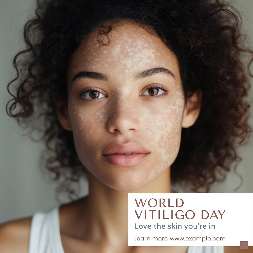World vitiligo day Instagram post template, editable text