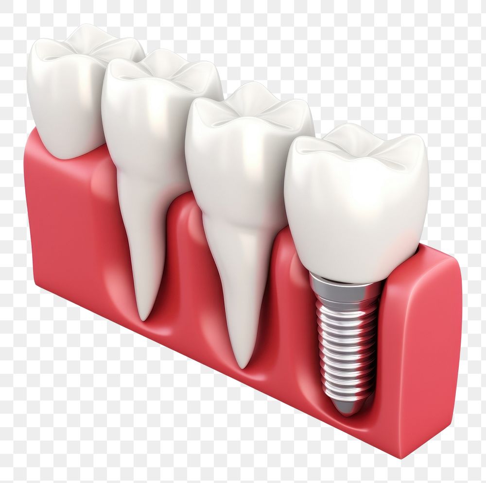 PNG dental implants, transparent background. AI generated Image by rawpixel