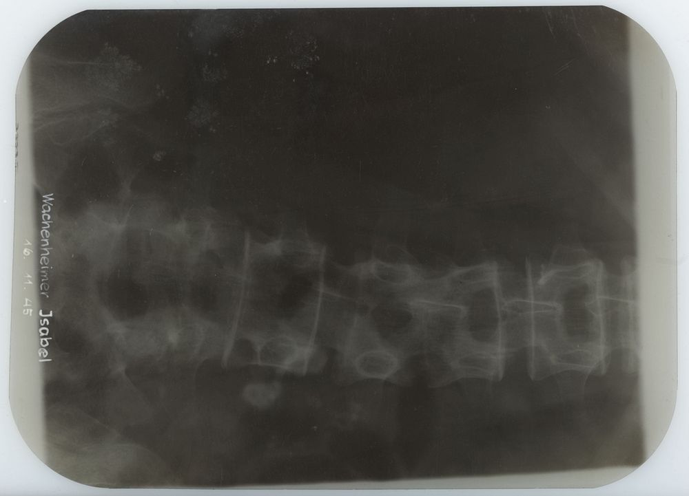 Röntgenfoto van de ruggengraat van Isabel Wachenheimer (1935) by anonymous
