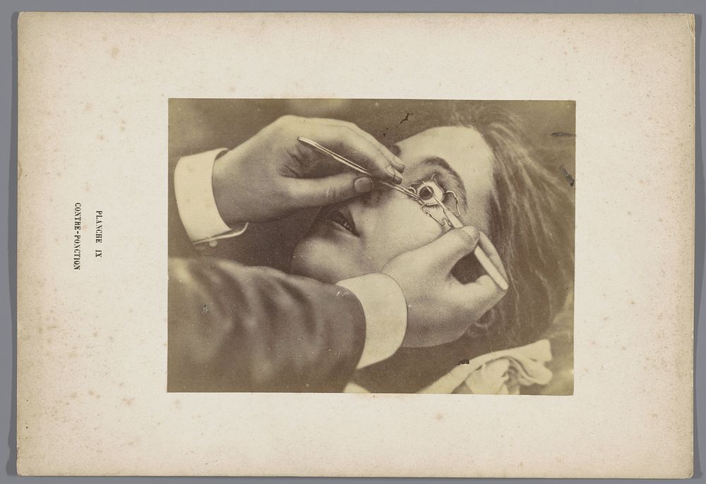 Verwijderen van staar tijdens een oogoperatie door middel van een tegenpunctie (c. 1865 - before c. 1870) by A de Montméja