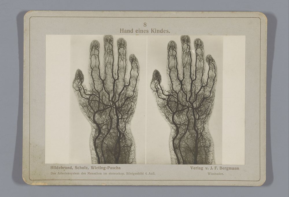 Röntgenopname van bloedvaten in een kinderhand (1917) by Otto Hildebrand, Wilhelm Scholz, Julius Menno Wieting Pascha and…