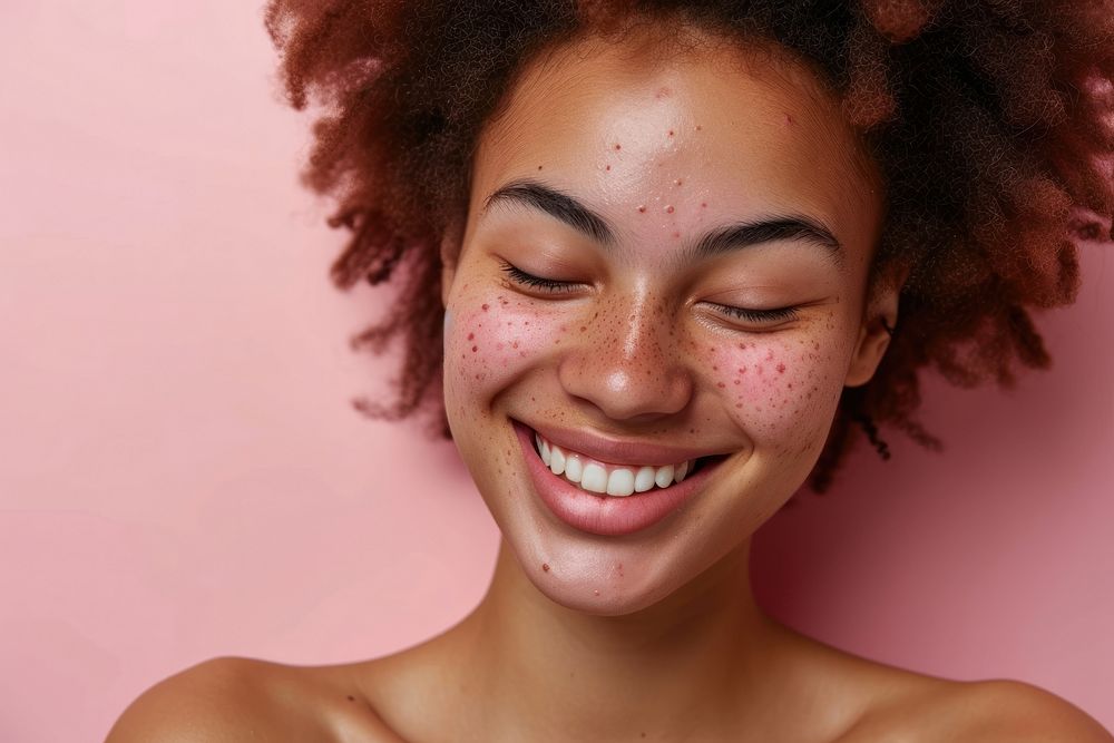 Happy multiracial young woman with a face full of acnes adult smile skin.