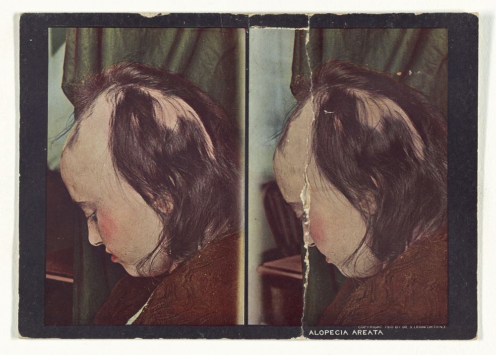 Alopecia Areata by Dr Selden I Rainforth