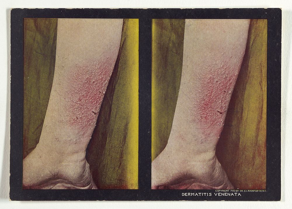 Dermatitis Venenata by Dr Selden I Rainforth
