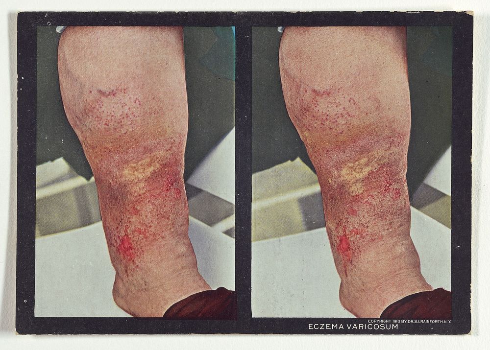 Eczema Varicosum. by Dr Selden I Rainforth