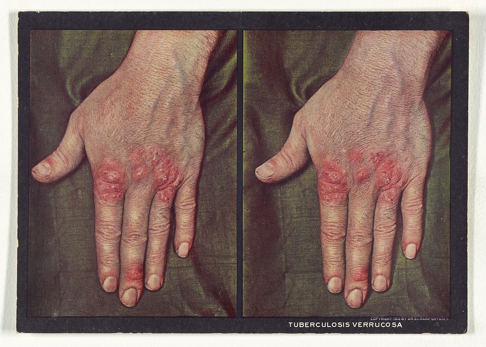 Tuberculosis Verrucosa by Dr Selden I Rainforth