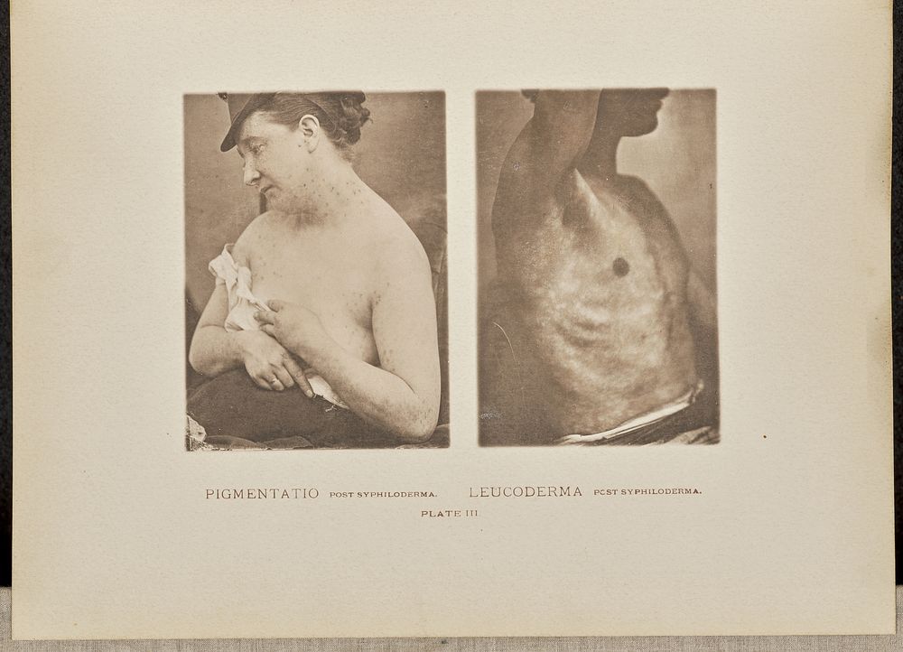 Pigmentatio post syphiloderma and leucoderma post syphiloderma by Dr George Henry Fox