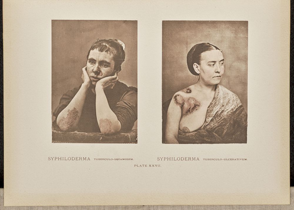 Syphiloderma tuberculo-squamosum and syphiloderma tuberculo-ulcerativum by Dr George Henry Fox
