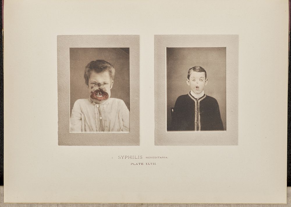 Syphilis hereditaria by O G Mason