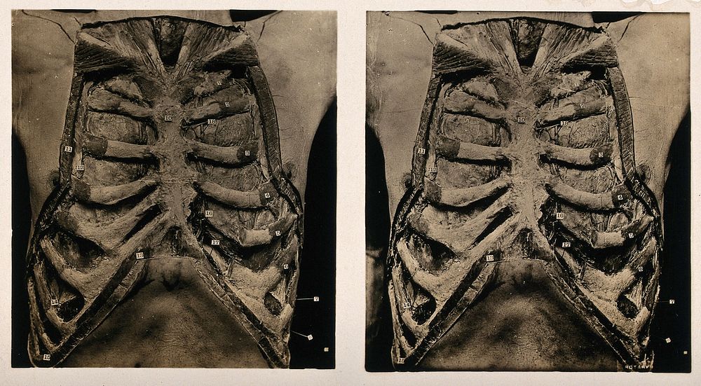 Anatomy: a dissection of the thorax: the thorax wall. Photograph, ca. 1900.