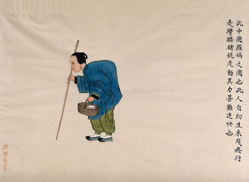 A woman with kyphosis (spinal curvature), walking with the aid of a stick. Watercolour by Zhou Pei Qun, ca. 1890.