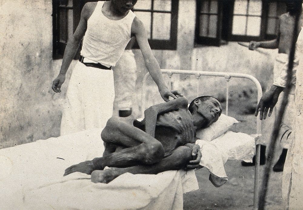 An emaciated man, rescued from a premature burial, lying on an outdoor hospital bed. Photograph.