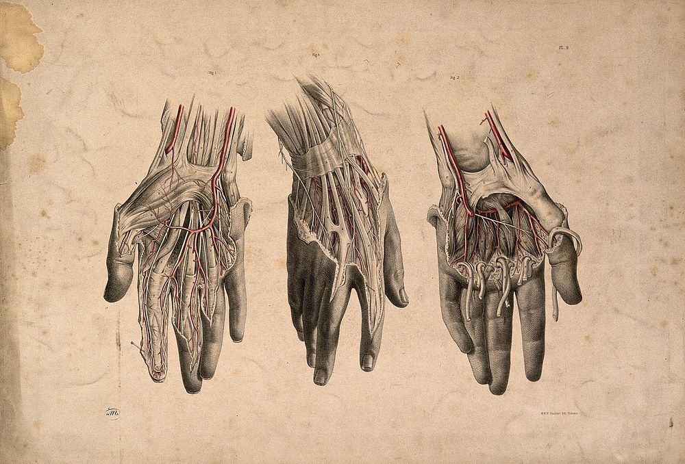 Dissection of the hand: three figures. Coloured lithograph by J. Maclise, 1851.