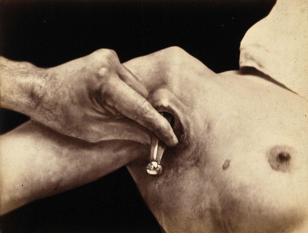 An operation in progress: a metal surgical implement is placed inside an incision in the armpit. Photograph by Félix Méheux…