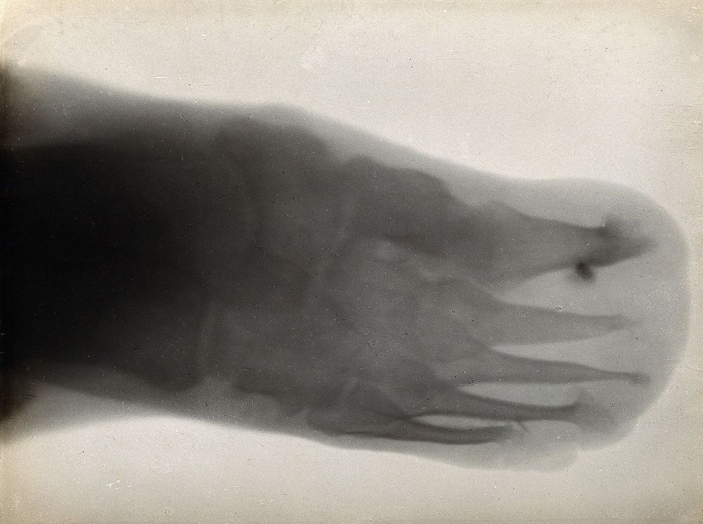 The bones of a foot, possibly with leprosy, viewed through x-ray. Photoprint from radiograph after Sir Arthur Schuster, 1896.