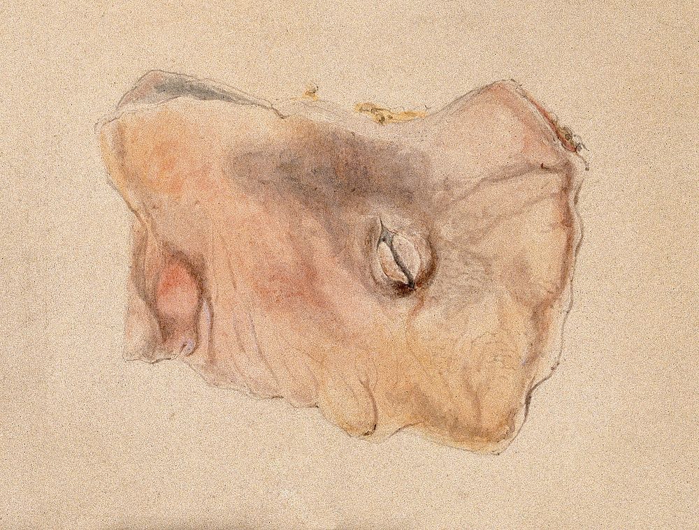 A stomach tumour; detail. Watercolour.