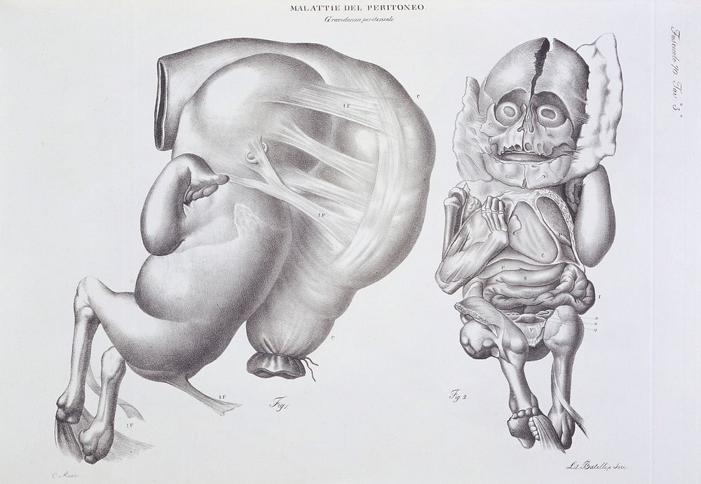 Diseases of the peritoneum. Peritoneal pregnancy