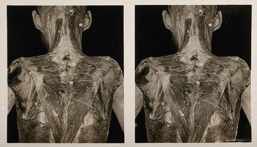 Anatomy: écorché human back, showing cutaneous nerves and the first layer of muscle. Photograph, ca. 1900.