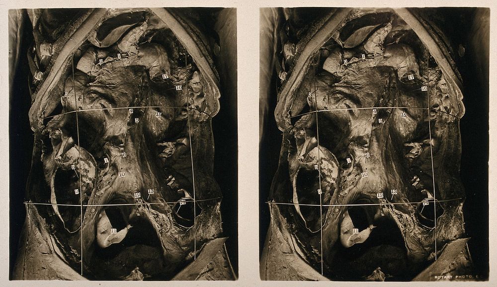 Anatomy: a dissection of the abdomen showing the abdominal cavity. Photograph, ca. 1900.
