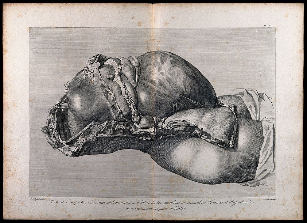Dissection of the pregnant female abdomen, showing the skin peeled away to reveal the swollen uterus and the viscera, side…