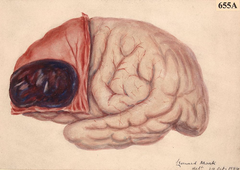 Subcranial haemorrhage over the anterior part of the left cerebral hemisphere