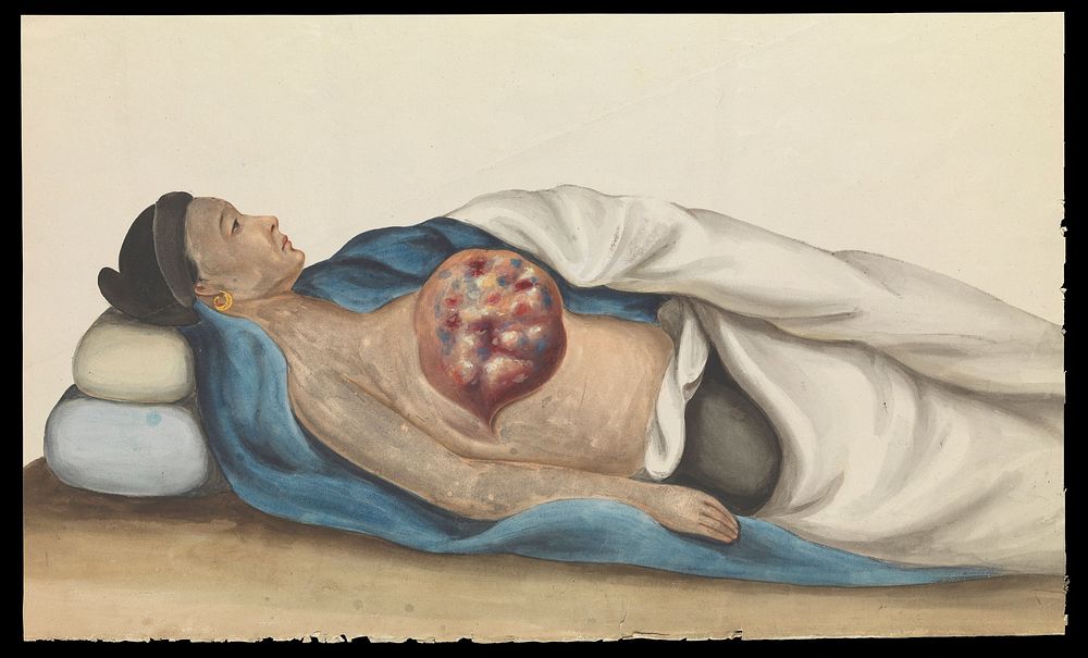 A woman, reclining, with a large tumour on her right breast. Gouache, 18--, after Lam Qua, ca. 1837.