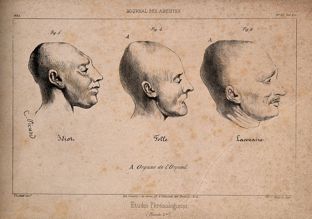 Three heads showing phrenological traits associated with insanity: a mentally defective person, a mad woman, and the…