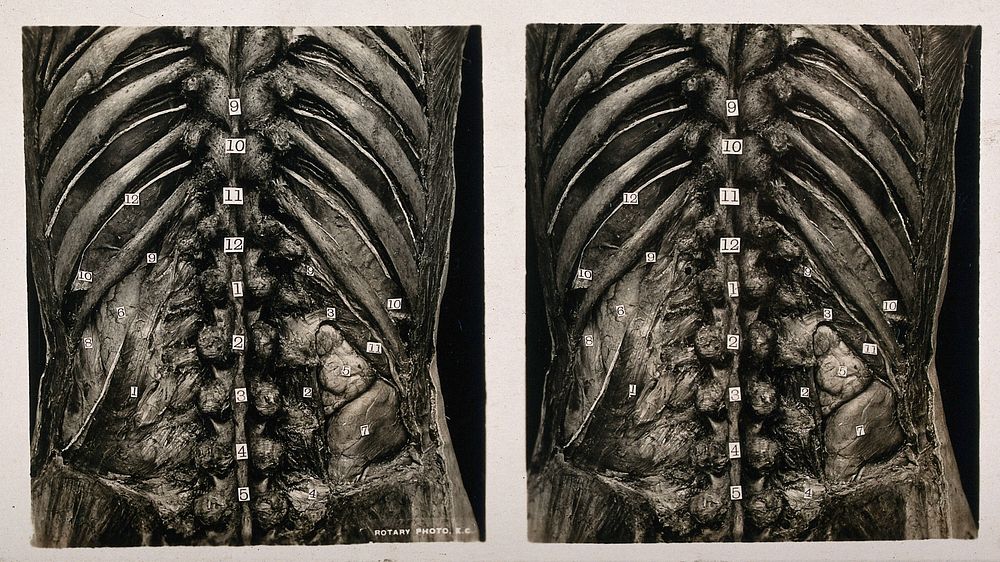 Anatomy: a dissection of the lumbar region showing the posterior relations of the kidneys. Photograph, ca. 1900.