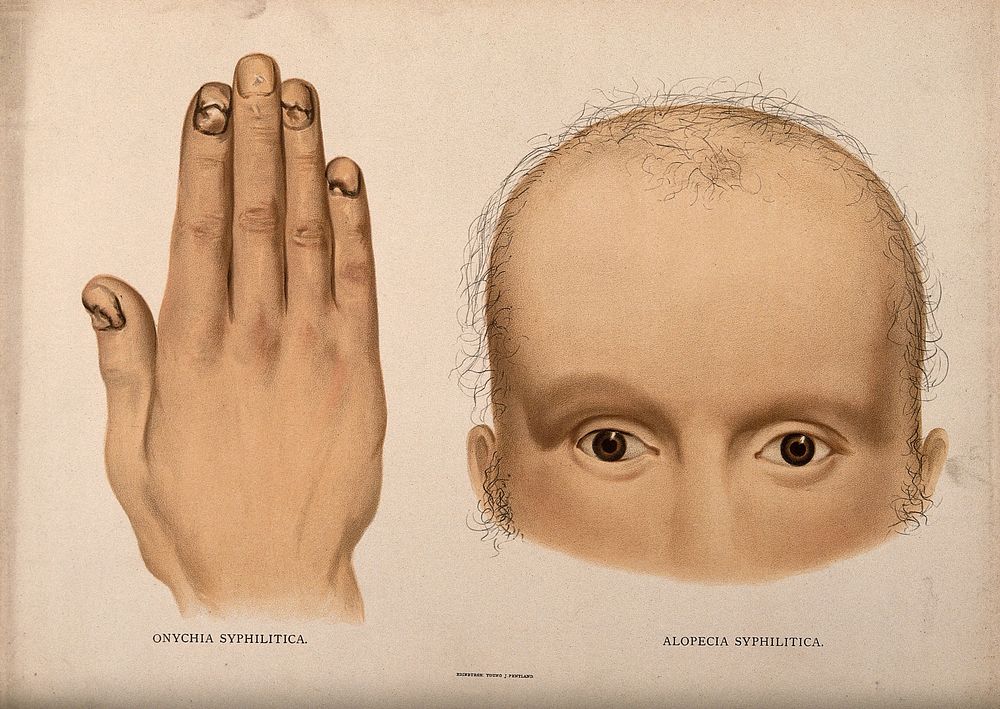 A hand with cracked and diseased fingernails; and the upper half of a face with severe hair loss (missing brows and lashes).…