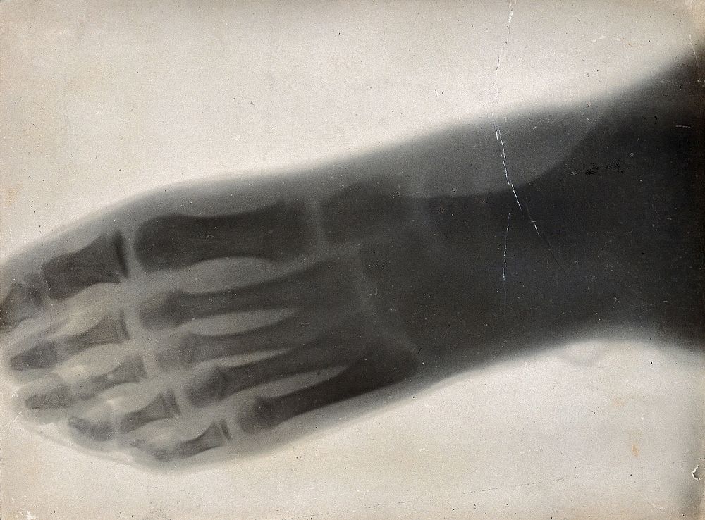 The bones of a foot, viewed through x-ray. Photoprint from radiograph after Sir Arthur Schuster, 1896.