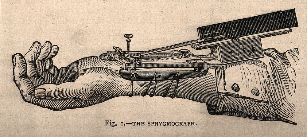 A sphygmograph: an instrument (also known as a 'pulsometer') for recording graphically the features of the pulse and…