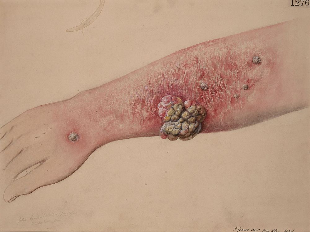 Left forearm of a wax-refiner who had a large recurrent epitheliomatous growth