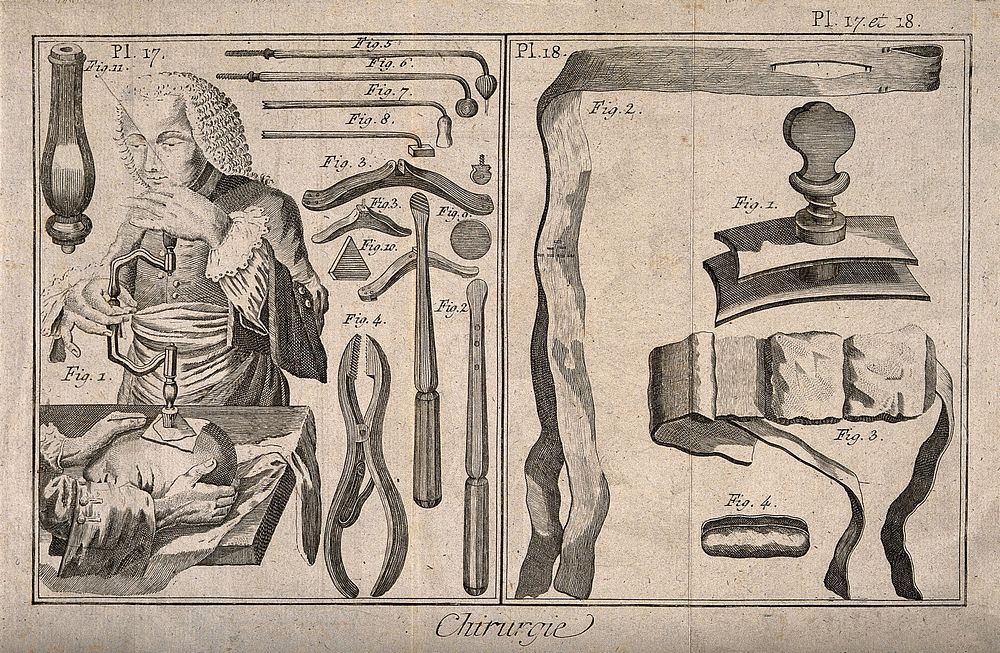 Surgical instruments and patients undergoing treatment (trepanation). Engraving with etching.