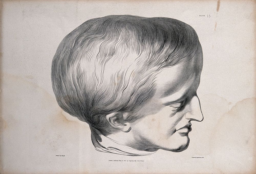 Head of James Cardinal: a man with a deformed skull. Lithograph after G. Scharf for Richard Bright, 1830.