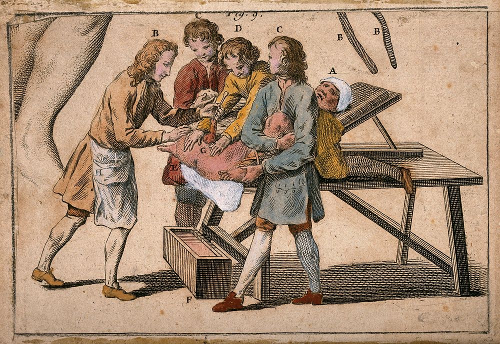 A surgeon performing a lithotomy on a patient who is being restrained by three assistants. Coloured engraving.