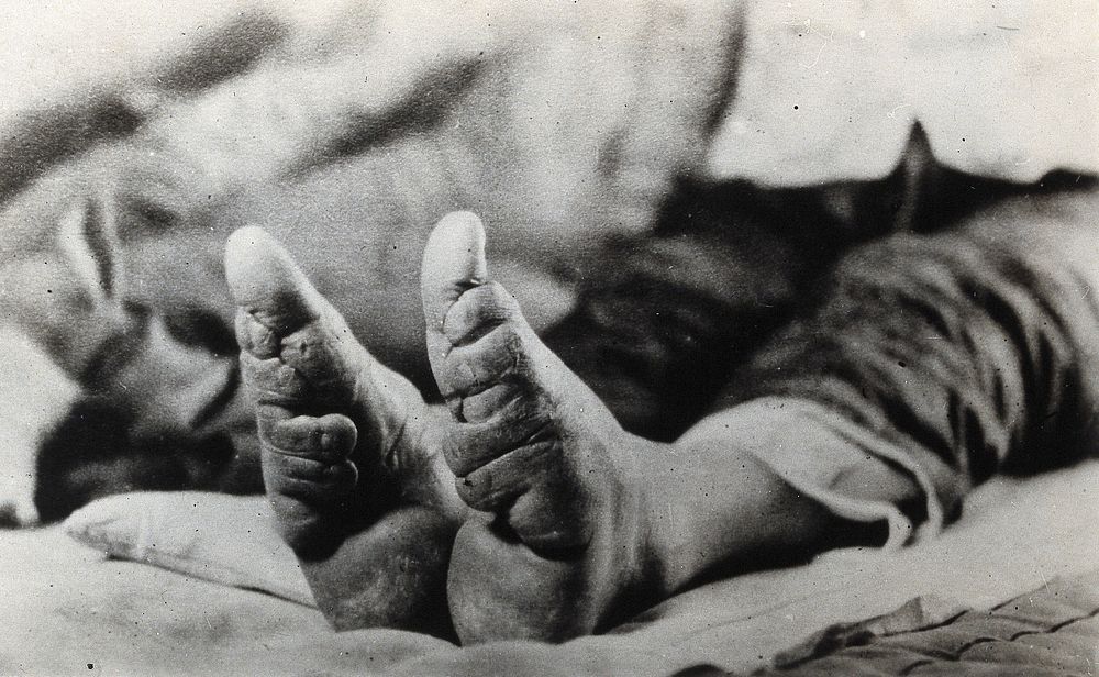 Feet of a Chinese woman, showing the effect of foot-binding. Photograph, 19--.