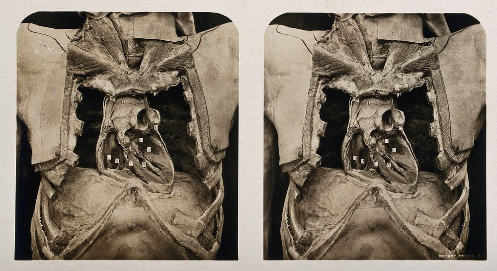 Anatomy: a dissection of the thorax showing the ventricular chambers of the heart. Photograph, ca. 1900.