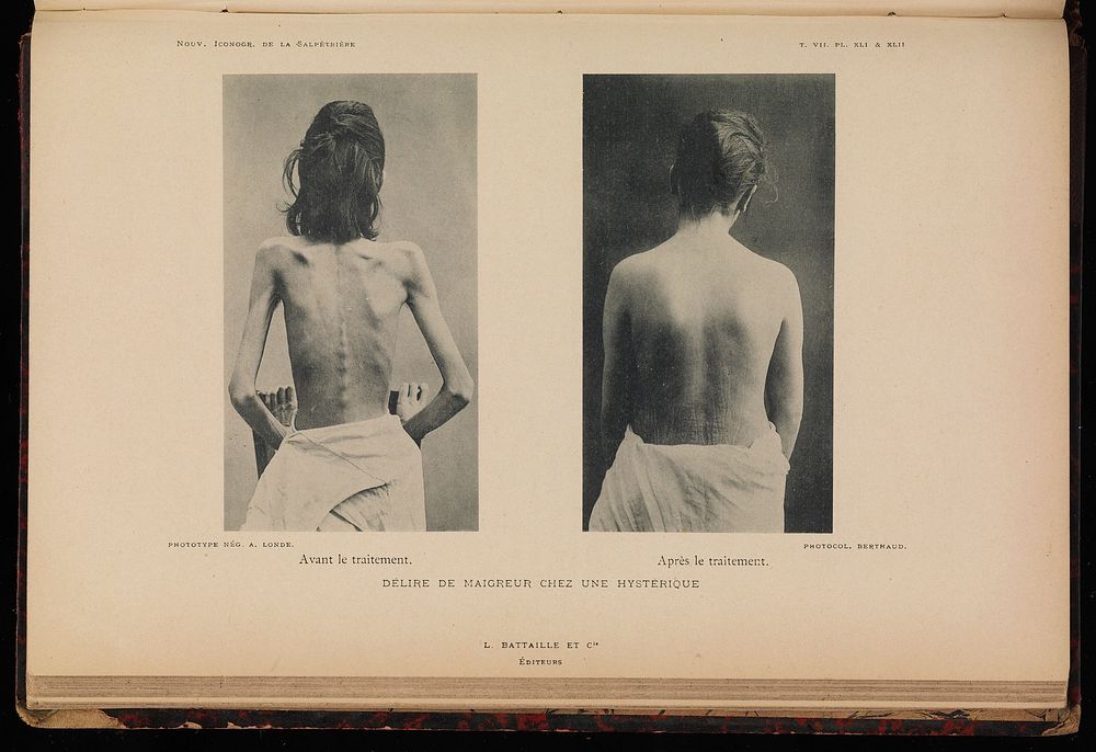 Two photographs, before and after treatment for anorexia