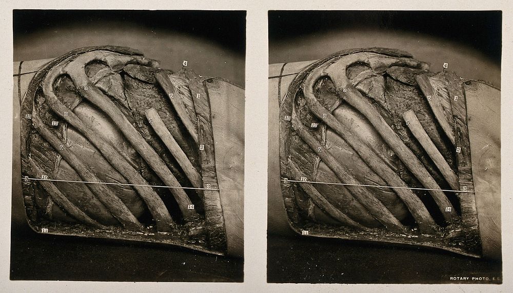 Anatomy: a dissection of the thorax showing the pleural cavity and lung, viewed from the left. Photograph, ca. 1900.