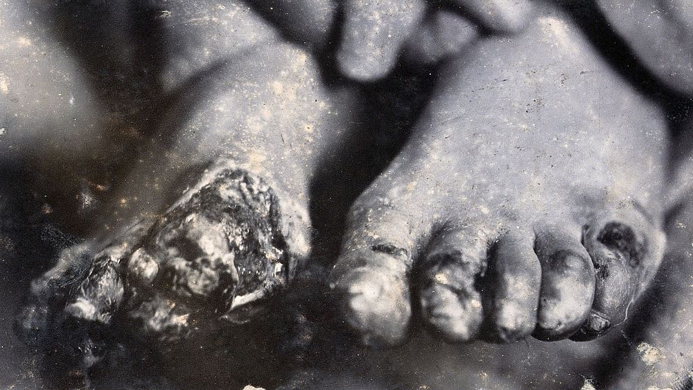 Friern Hospital, London: feet, the right one partly destroyed, possibly by syphilis. Photograph, 1890/1910.