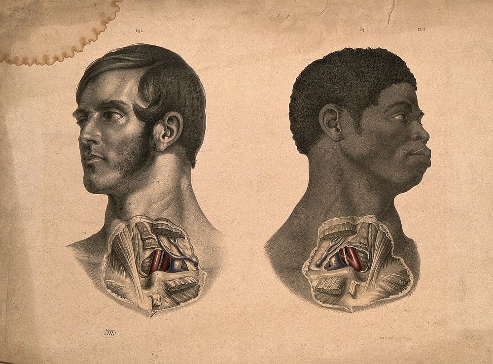 Two heads of men (one white, one black African), showing dissection of muscles and blood-vessels of the subclavian region of…
